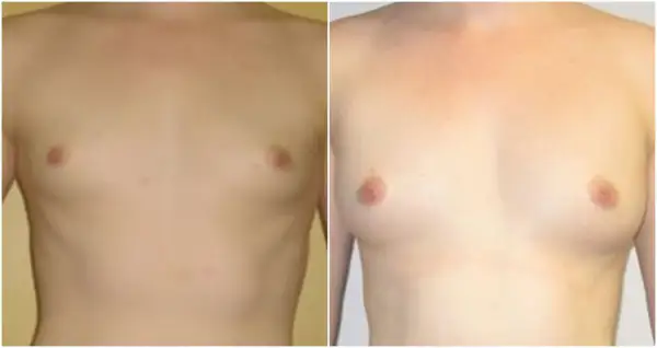 Przed i po lipotransferze biustu: widoczne powiększenie i wymodelowanie piersi. Efekty lipotransferu biustu są widoczne.