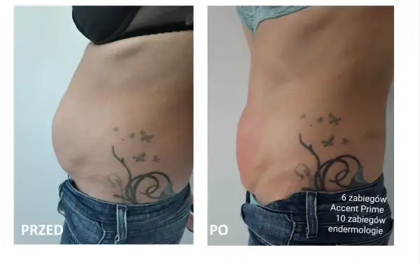 Przed i po zabiegach Accent Prime i endermologii. Widoczna redukcja tkanki tłuszczowej, efekt podobny do liposukcji kawitacyjnej.