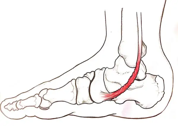 Illustrazione anatomica del piede con tendine d'Achille infiammato, evidenziando la **tendinite caviglia**.