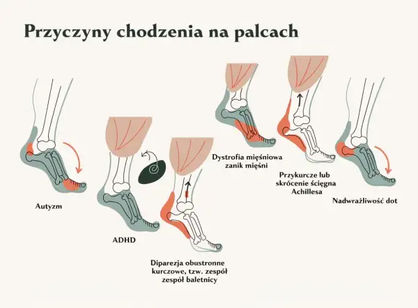 Ilustracja pokazuje, że dziecko chodzi na palcach z różnych powodów: autyzm, ADHD, dystrofia mięśniowa, przykurcz ścięgna Achillesa, dipareza kurczowa i nadwrażliwość dotykowa.