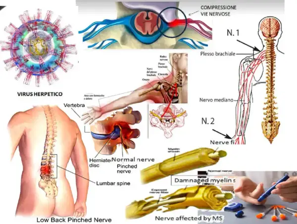 Immagine illustra cause di dolore neuropatico e neuropatia periferica: virus, compressione nervosa, ernia del disco, danni alla mielina.