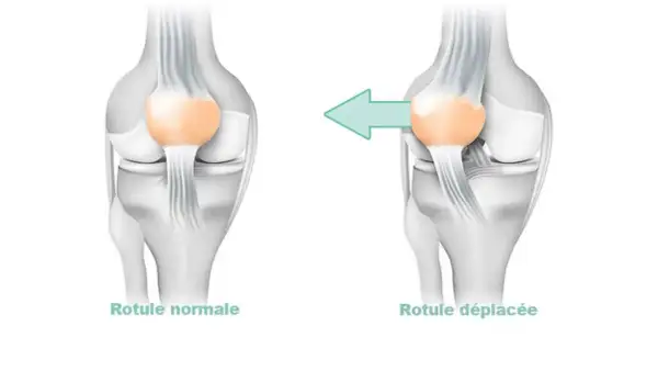 Comparaison d'une rotule normale et d'une rotule déplacée, illustrant la **dysplasie femoro patellaire**.