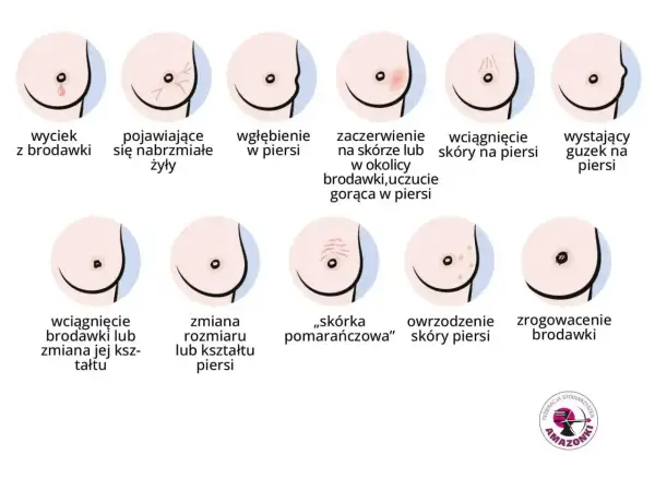Ilustracja pokazuje różne zmiany w piersiach, w tym wyciek z brodawki, zaczerwienienie, wgłębienie, guzek, zmiany skórne i zrogowacenie.