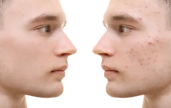 Gesichtsprofil links: reine Haut. Rechts: Akne-Ausbrüche, die durch Omega-3-Fettsäuren verbessert werden könnten.