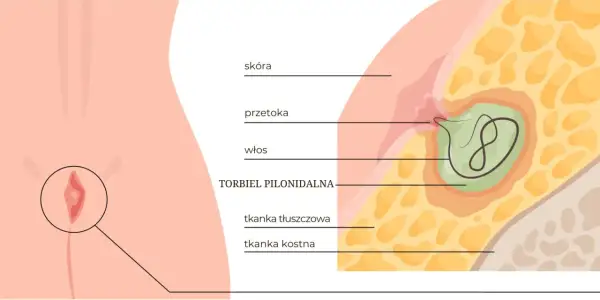 Przekrój skóry ukazujący torbiel pilonidalną z włosiem w środku, otoczoną tkanką tłuszczową i kostną.