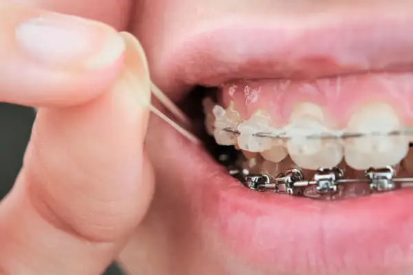 Dita che posizionano elastici sull'apparecchio dentale. A volte gli elastici apparecchio fanno male, ma sono necessari per allineare i denti.