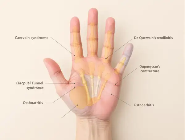Anatomie de la main droite montrant les causes de douleur : syndrome de De Quervain, contracture de Dupuytren, syndrome du canal carpien, arthrose.