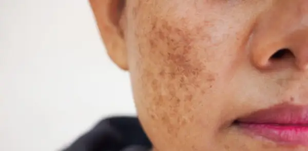 Gros plan sur une joue présentant une hyperpigmentation, avec des taches brunes visibles. Une solution de traitement hyperpigmentation est recherchée.