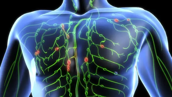 Das Lymphsystem des menschlichen Oberkörpers mit hervorgehobenen Lymphknoten. Dies kann helfen zu verstehen, was ein Lymphom ist.