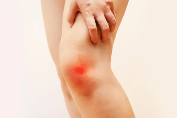 Gamba con ginocchio arrossato e mano che lo stringe, indicando dolore. Cosa fare per il dolore alle ginocchia.