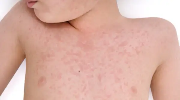 Alergia pokarmowa u dzieci: objawy skórne, przyczyny i jak pomóc?