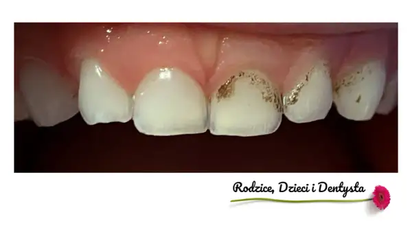 Zbliżenie na zęby dziecka z widocznymi przebarwieniami, które mogą wskazywać na próchnicę. Czarne zęby u dzieci to sygnał do wizyty u dentysty.