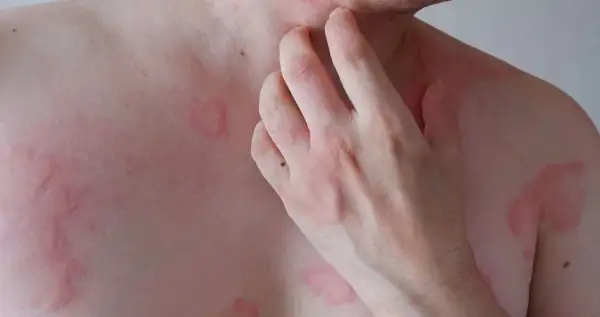 Czy pietruszka uczula? Objawy alergii, które warto znać