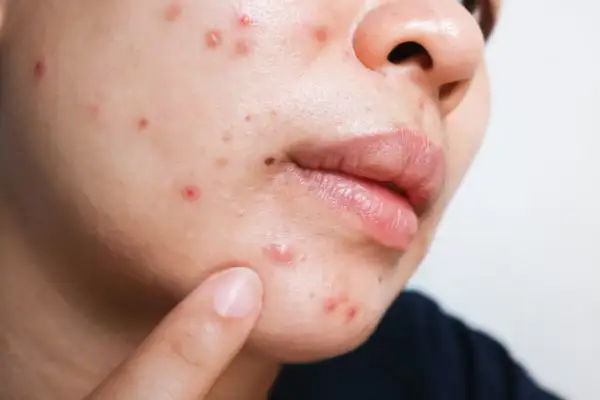 Piel con brotes y rojeces, posible queratosis pilaris. ¿Será el gluten el culpable?