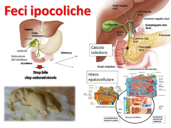 Feci ipocoliche, color argilla, dovute a ostruzione biliare. L'immagine mostra un diagramma del sistema biliare e un esempio di feci chiare.