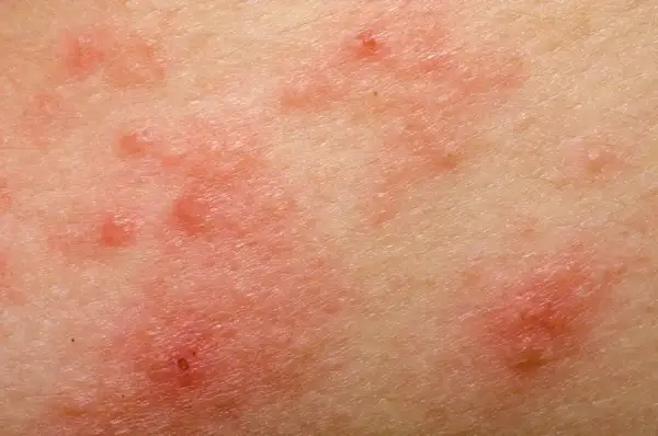Skóra z zaczerwienionymi, swędzącymi zmianami, które mogą być objawem uczulenia na gluten.