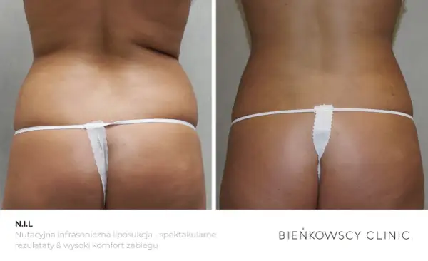 Przed i po zabiegu N.I.L. - ultradźwiękowa liposukcja. Czy liposukcja jest bezpieczna? Tak, gdy wykonana przez specjalistów. Spektakularne rezultaty.