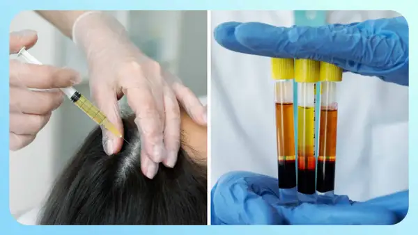 Manos enguantadas aplicando mesoterapia capilar con jeringa y mostrando tubos de ensayo con plasma.