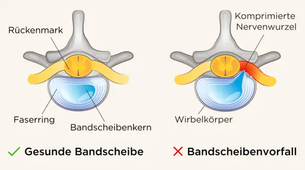 Vergleich einer gesunden Bandscheibe mit einem Bandscheibenvorfall, der eine Nervenwurzel komprimiert und so Symptome verursacht.