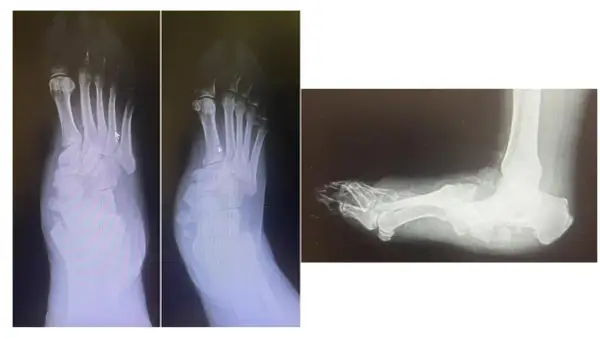 Radiografie del piede con deformità tipica del piede di Charcot, in preparazione per un intervento chirurgico.