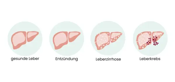 Illustration zeigt gesunde Leber, Entzündung, Leberzirrhose und Leberkrebs. Frühe Anzeichen von Leberkrebs sind oft unspezifisch.