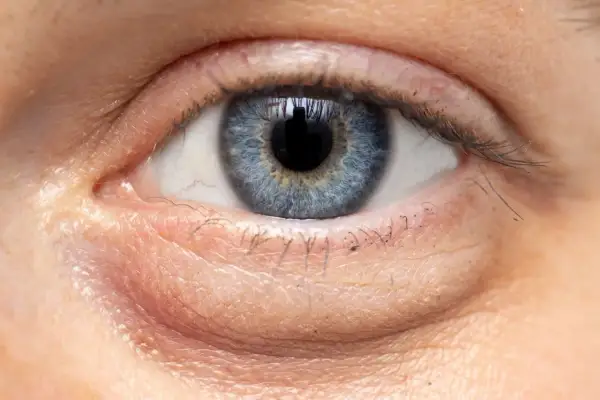Widoczne worki pod oczami, które mogą mieć różne przyczyny. Skóra wokół oka jest zaczerwieniona i lekko opuchnięta.