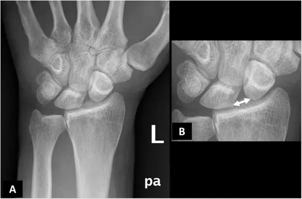 Radiografie del polso. L'immagine B evidenzia un aumento dello spazio tra radio e ulna, indicativo di lesione del legamento triangolare polso.