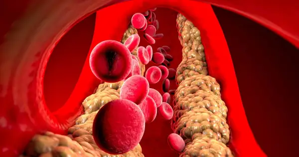 Czerwone krwinki przepływają przez zatłuszczone naczynie krwionośne, gdzie cholesterol HDL podwyższony tworzy złogi.
