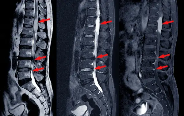 MRI kręgosłupa lędźwiowego pokazuje przepuklinę dysku, która może powodować silny ból. Czerwone strzałki wskazują na ucisk na rdzeń kręgowy.