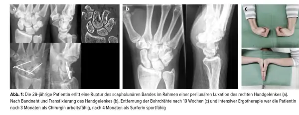 Röntgenbilder zeigen das distale Handgelenk vor und nach einer Operation.
Die Patientin ist nach 3 Monaten wieder arbeitsfähig.
