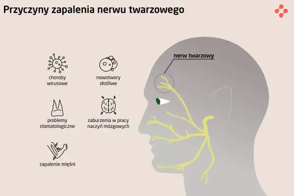 Ilustracja przedstawia przyczyny zapalenia nerwu twarzowego: wirusy, nowotwory, problemy stomatologiczne, zaburzenia naczyń mózgowych i zapalenie mięśni.