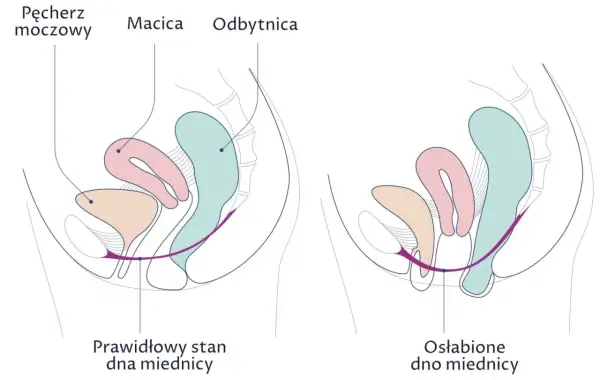Porównanie prawidłowego i osłabionego dna miednicy. Na drugim obrazku widać obniżenie narządów, co może prowadzić do wypadania pochwy.