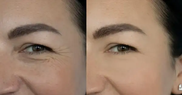 Porównanie skóry: po lewej widoczne zmarszczki wokół oka, po prawej wygładzona skóra. Niesamowite retinol efekty!
