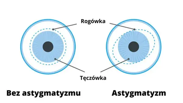 Astygmatyzm: Czy okulary są konieczne? Sprawdź, od czego zależy