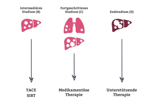 Illustration zeigt Leberstadien mit zunehmenden Metastasen. Stadium B: Leber mit wenigen Metastasen, Therapie TACE/SIRT. Stadium C: Lunge und Leber mit Metastasen, medikamentöse Therapie. Stadium D: Leber mit vielen Metastasen, unterstützende Therapie.