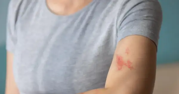 Skóra na ramieniu z zaczerwienionymi, swędzącymi zmianami, które mogą wymagać maści na liszaj.