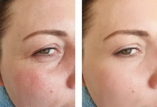 Comparaison avant/après : la peau ridée à gauche est lissée à droite, montrant l'efficacité du tretinoin vs retinol pour réduire les rides.