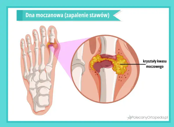 Dna moczanowa: zapalenie stawu palucha z kryształami kwasu moczowego. Jakie badania pomogą zdiagnozować tę chorobę?