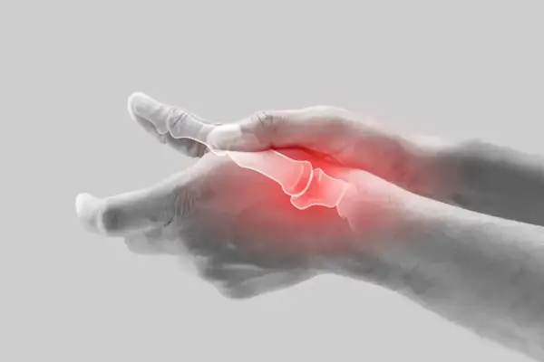 Schmerzende Hand mit gerötetem processus styloideus radii.