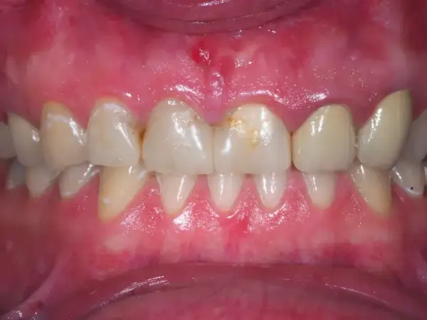 Podrażnione dziąsła: Szybka ulga i trwałe rozwiązanie. Kiedy do dentysty?