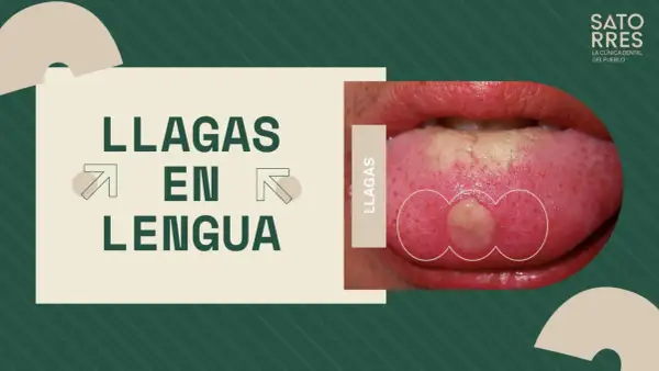 Una llaga con pus en la lengua, destacada en un gráfico que dice "LLAGAS EN LENGUA".