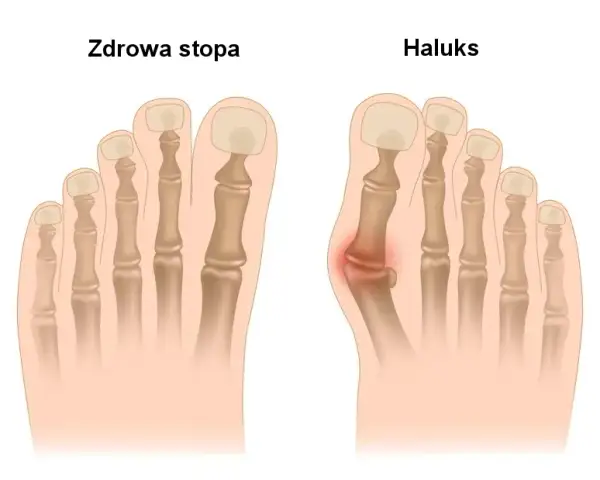 Czy to haluks? Zobacz, jak rozpoznać paluch koślawy na stopie