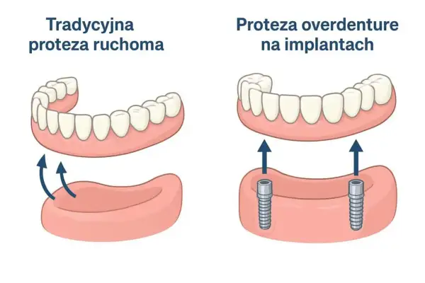 Porównanie protezy ruchomej i protezy na implantach. Prawidłowa higiena jamy ustnej po wszczepieniu implantu jest kluczowa.