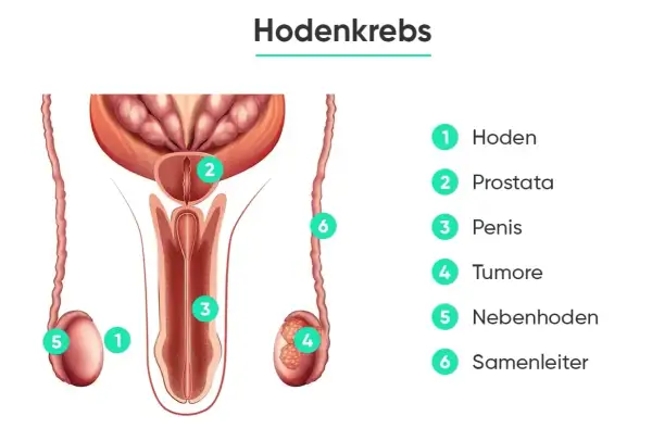 Anatomische Darstellung des männlichen Genitalbereichs mit Markierungen für Hoden, Prostata, Penis, Tumore, Nebenhoden und Samenleiter. Wichtige Informationen zur Hodenkrebs Therapie.