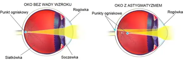 Astygmatyzm u dorosłych: Czy ustępuje? Poznaj metody korekcji