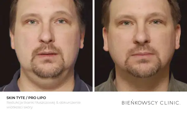 Przed i po zabiegu redukcji tkanki tłuszczowej. Widoczne lipoliza ud efekty, poprawa konturu twarzy i napięcie skóry.