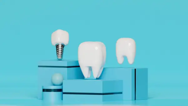 Un implante dental junto a dientes, sobre cubos azules.
