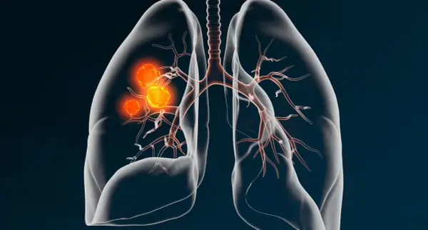 Darstellung von Lungenkrebs (NSCLC) mit leuchtend orangefarbenen Tumoren, die sich in den Bronchien ausbreiten. Medizinische Illustration.