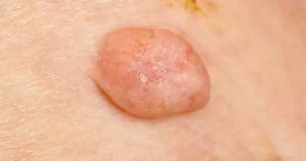 Kłykciny kończyste: do dermatologa, urologa czy ginekologa?