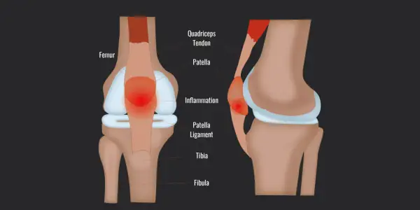 Entzündung der Patella Sehne am Kniegelenk, mit Femur, Patella und Tibia.